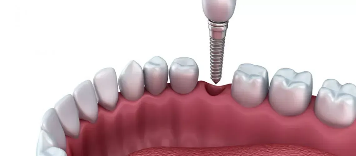 Why Choose Dental Implants