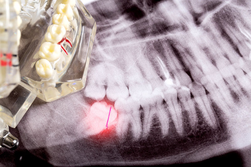 This image shows an X-ray of teeth with a highlighted wisdom tooth at the bottom left. A dental model is also partially visible.
