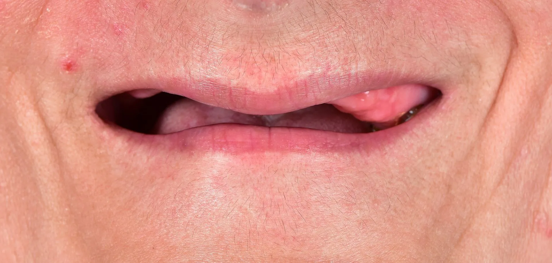 Dental Implants Before Img