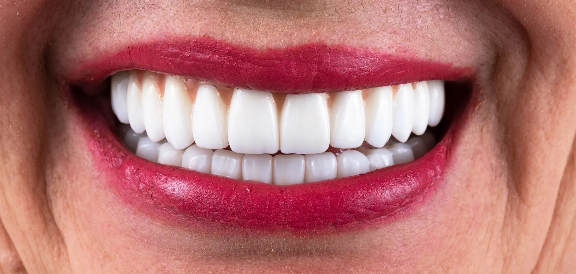 Dental Implants After Img