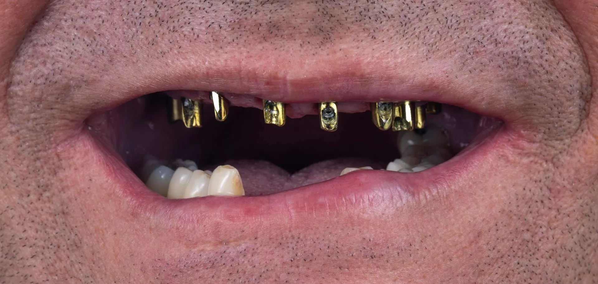 Dental Implants Before Img 2