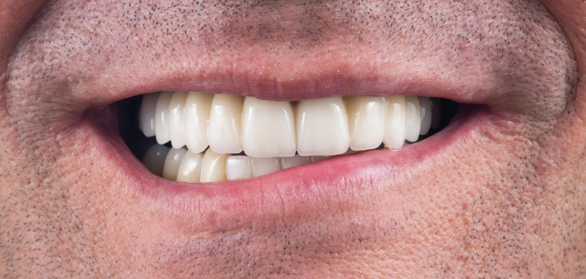 Dental Implants After Img 2