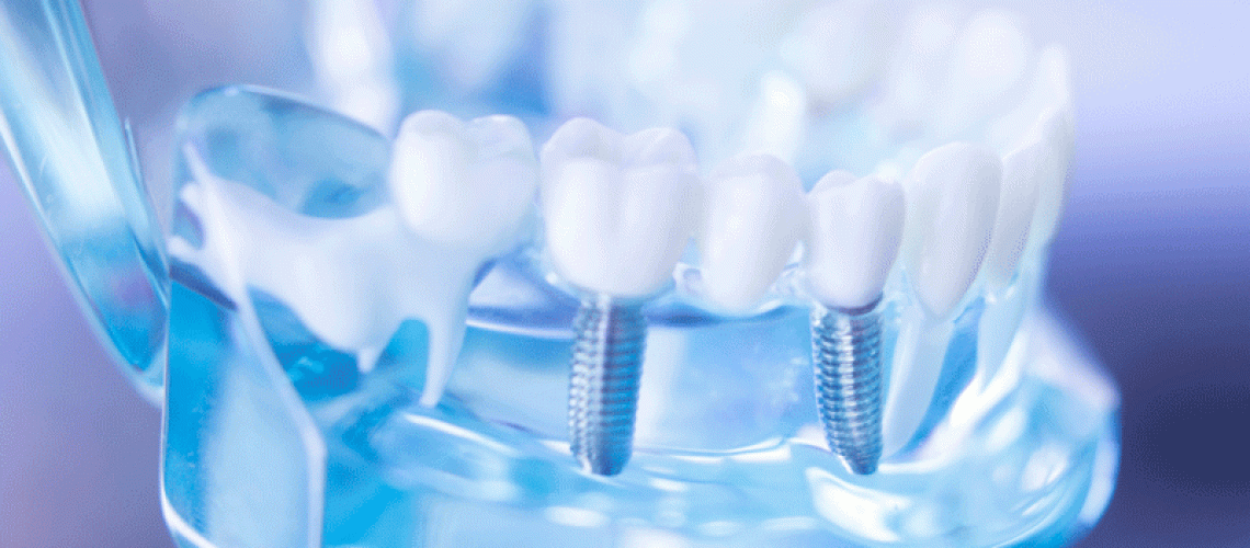 Dental Implant Procedure Animation