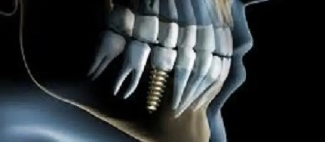 Dental Implant Jaw