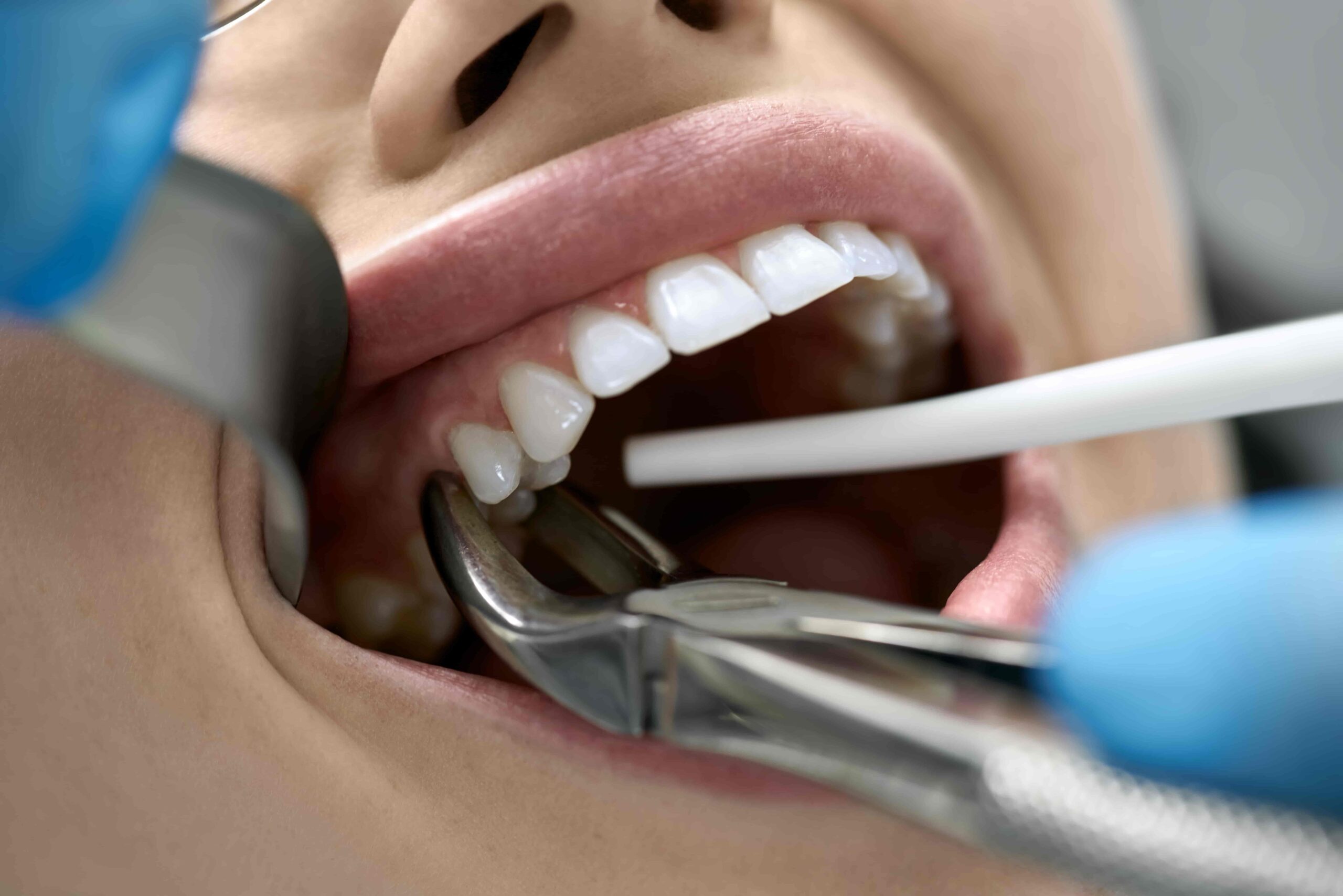 Extractions banner Image