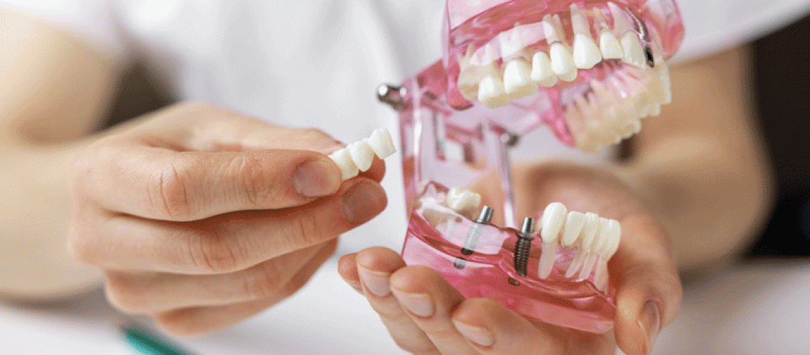 Dental Implants Promotion Animation