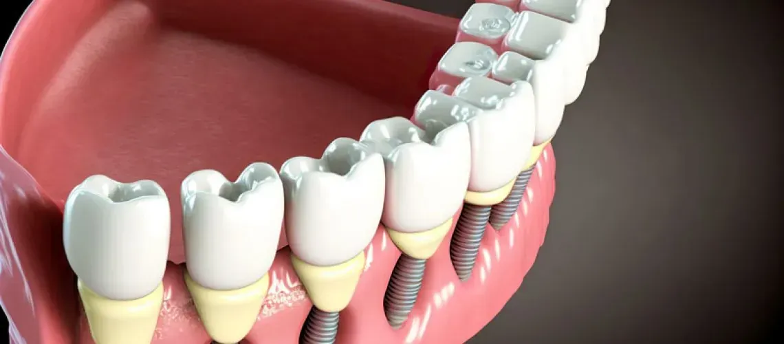 Full Mouth Implants Photo