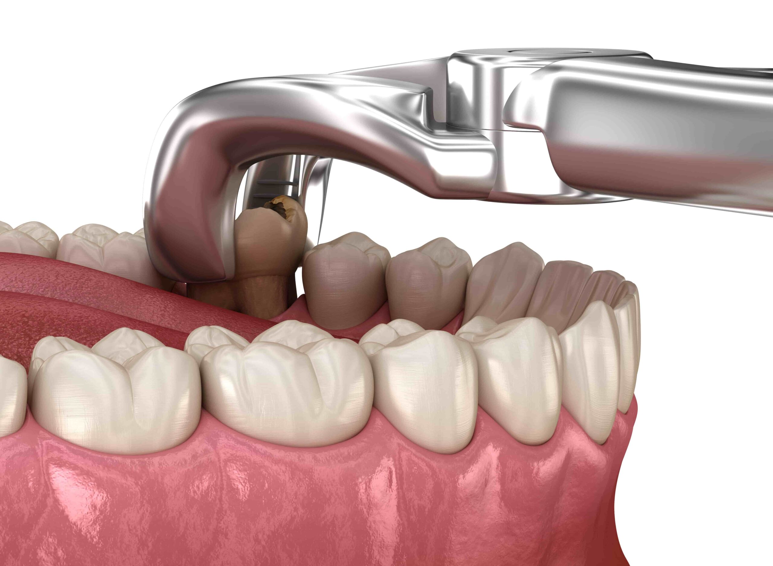 Tooth Extractions Banner Image