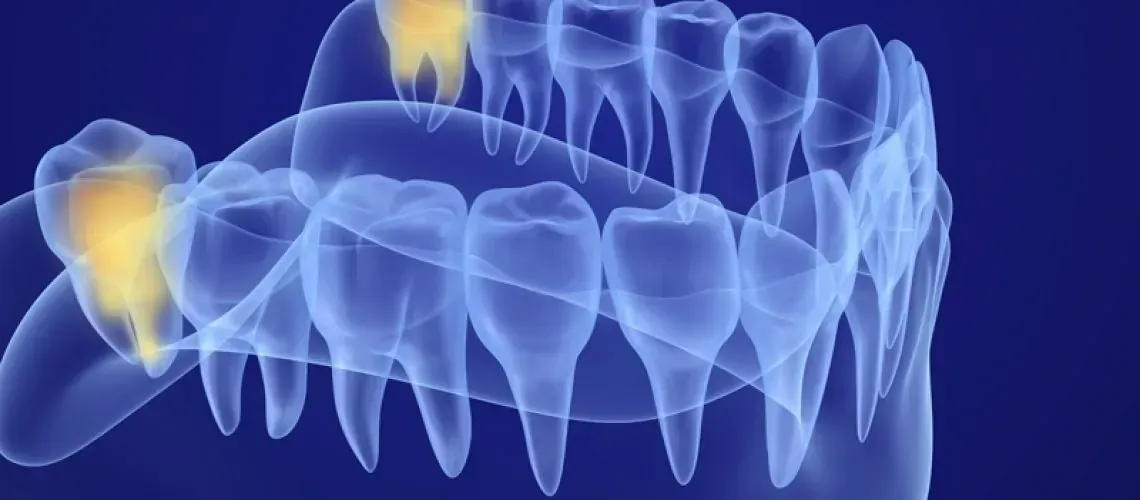 Wisdom Tooth Needing Removal
