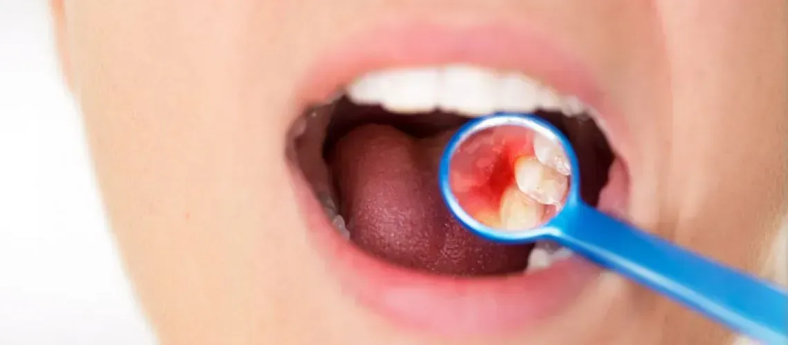 Implants and Gum Disease