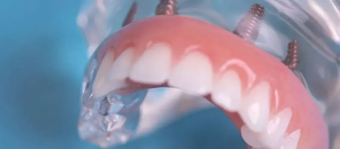 Post Dental Implant