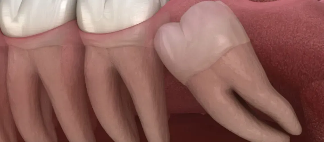 Wisdom Teeth Blog Img