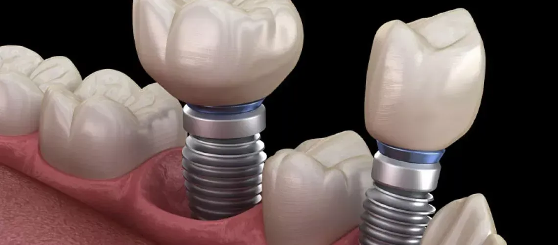 Implant Surgery Pain