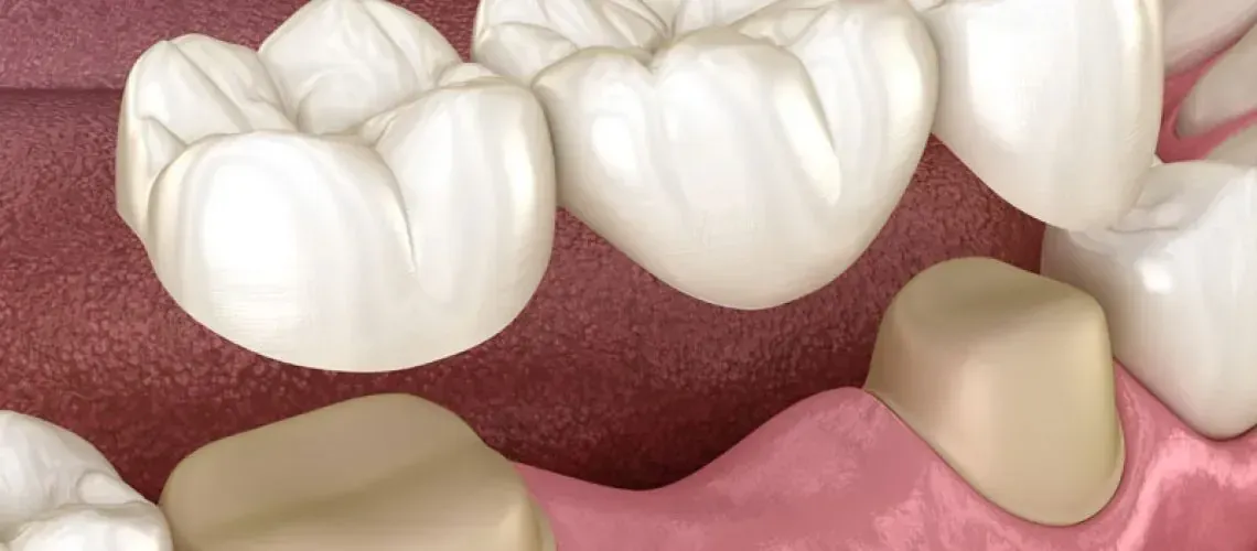 Get A Dental Bridge