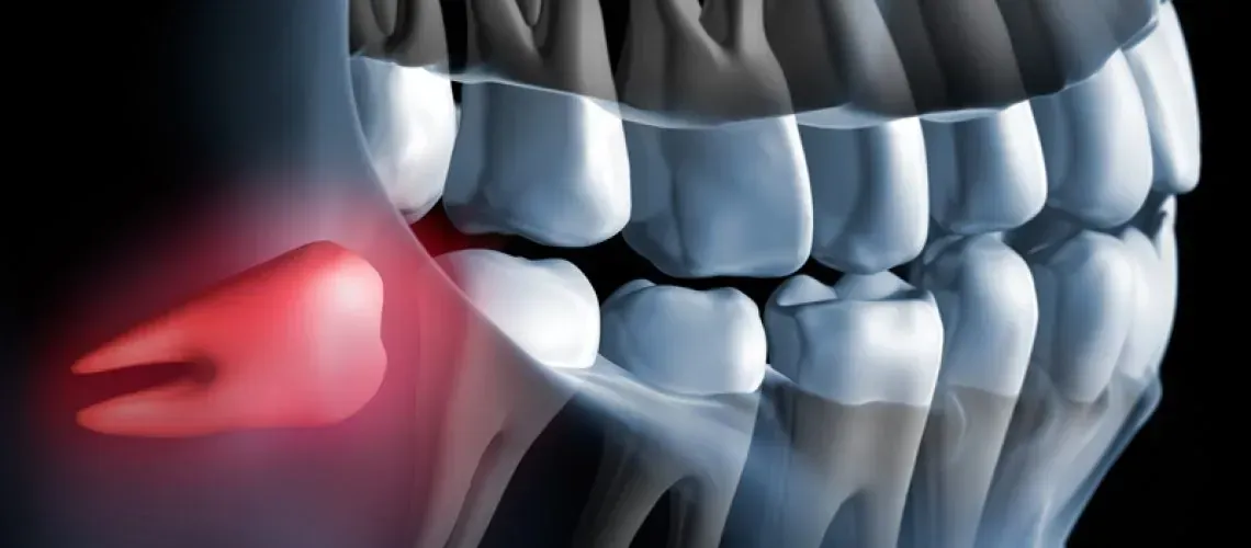 Wisdom Teeth Removal Image