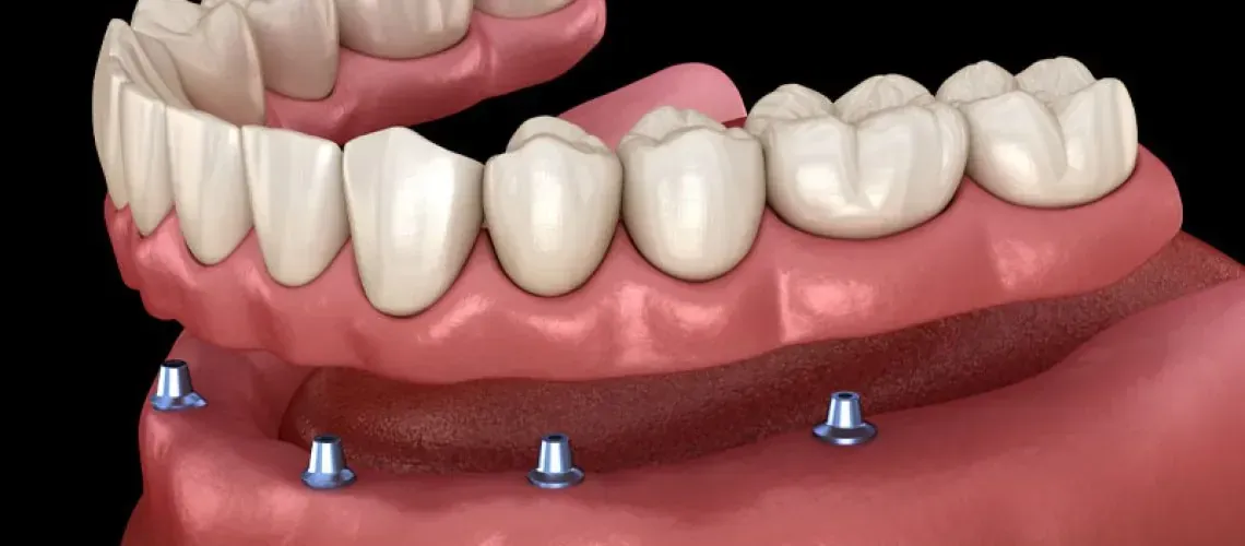 Implant-Supported Dentures Model