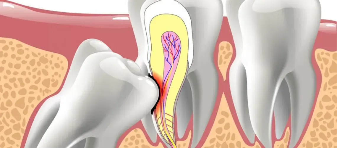 Impacted Wisdom Tooth X-Ray