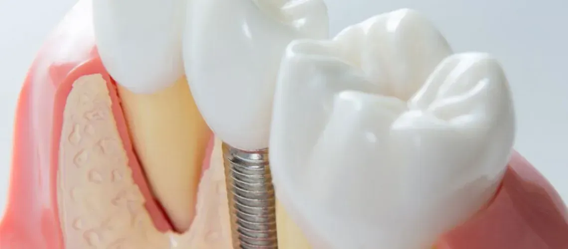 Wisdom-Tooth Removal Complications