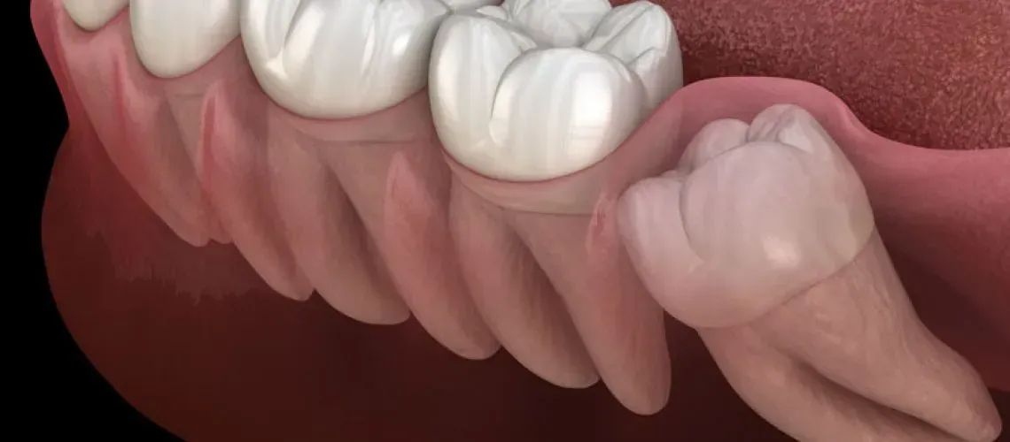 Implant-Supported Dentures Benefits