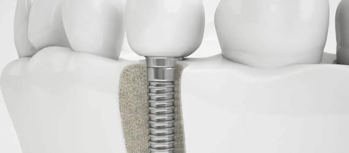 Multiple Implant Procedure