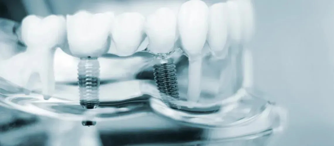 Wisdom-Tooth Removal Steps