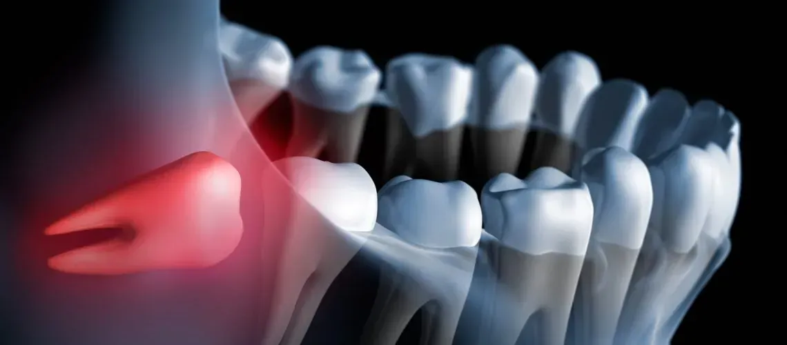 Tooth Model with Dental Implant