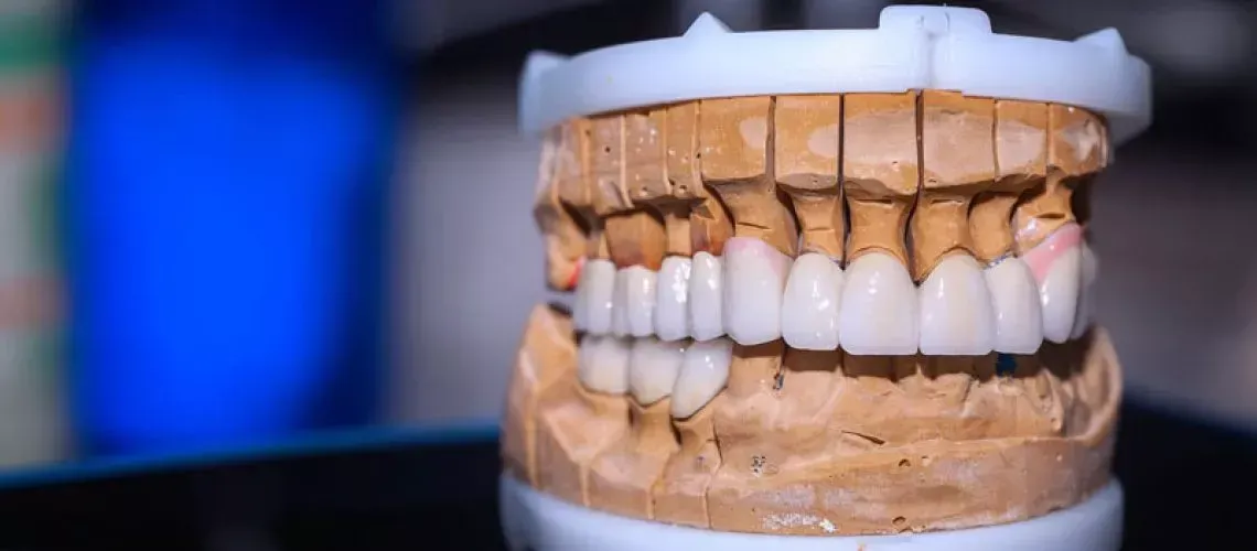 Full Arch Replacement Options