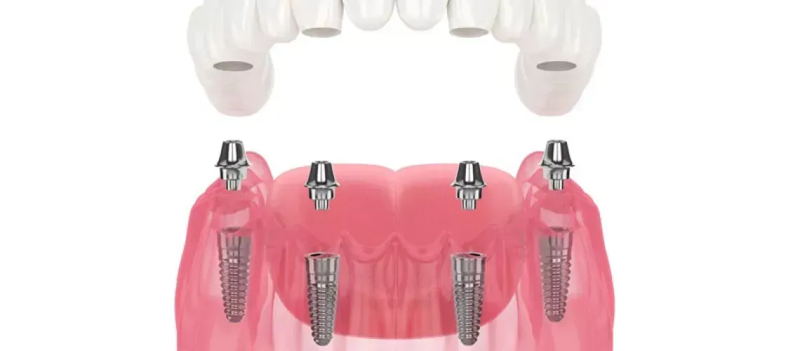 Implant Dentures Treat Symptoms