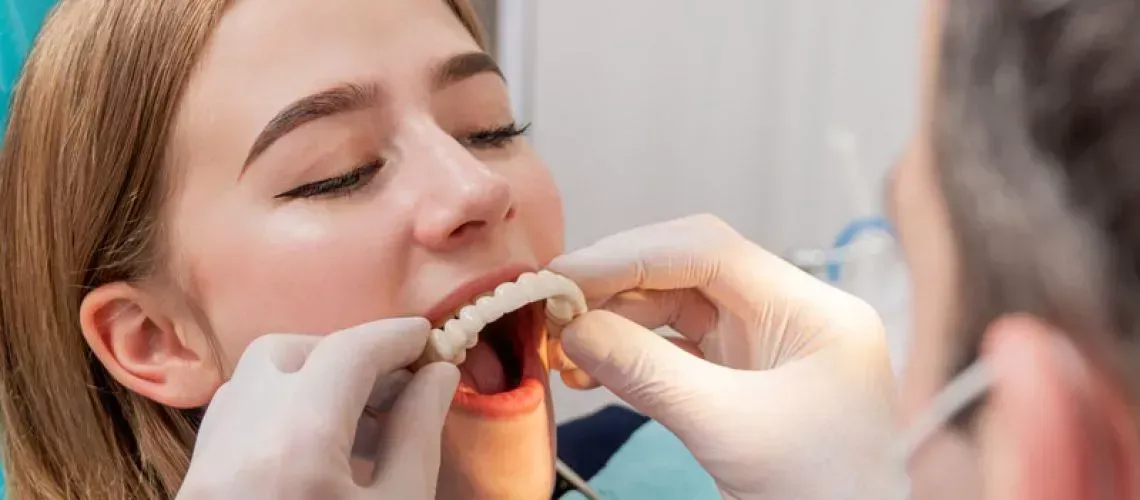 Full Mouth Implant Benefits