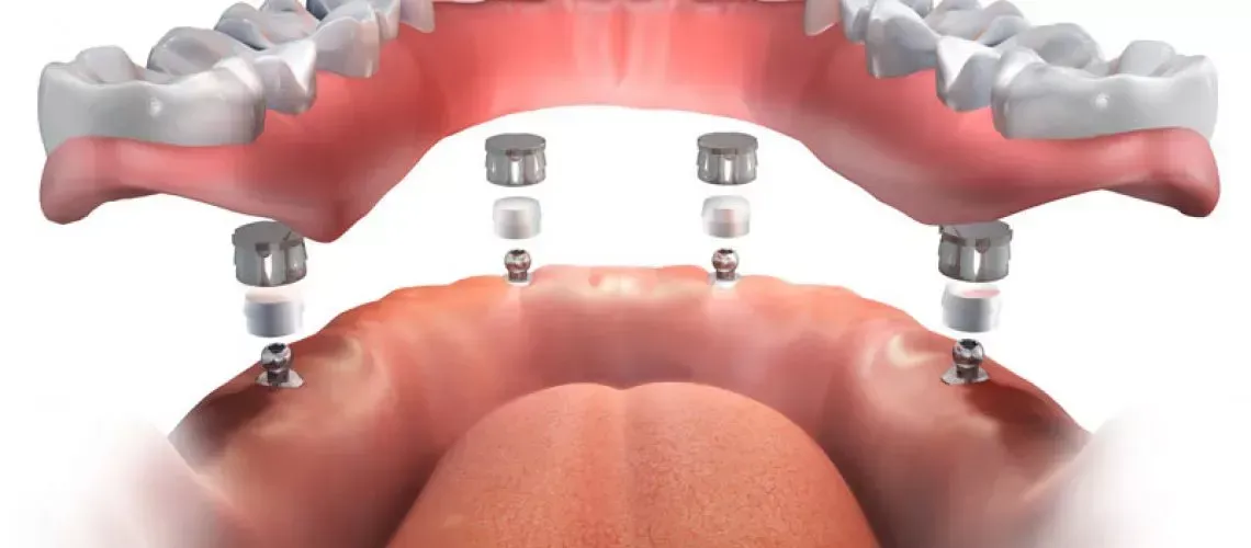 Implant-Supported Dentures Benefits