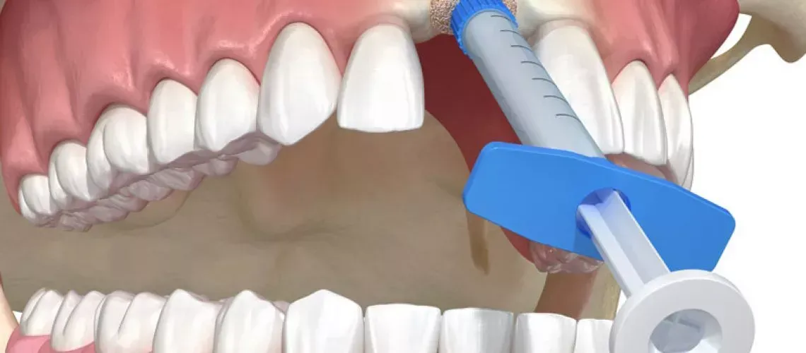 Need Bone Grafting?