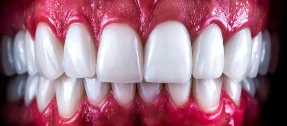 Full Mouth Implant Overview