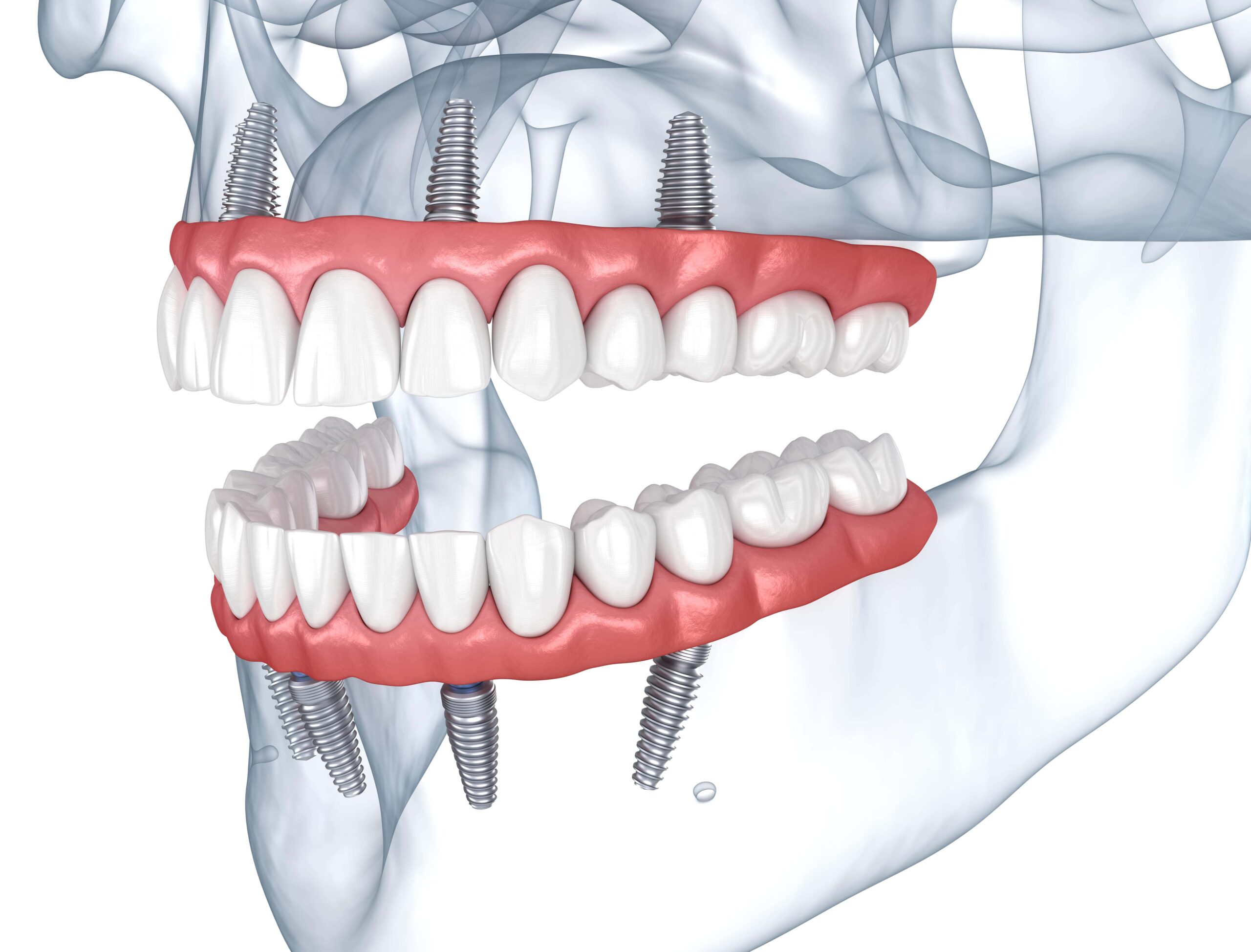 Full Mouth Reconstruction