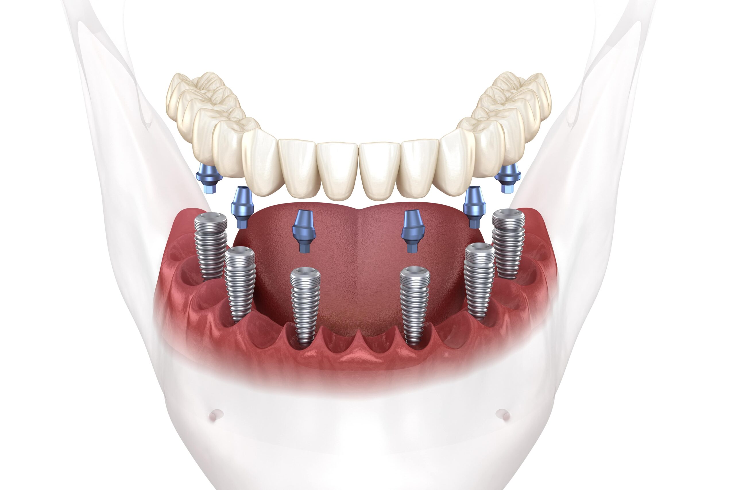 Implant-Supported Dentures