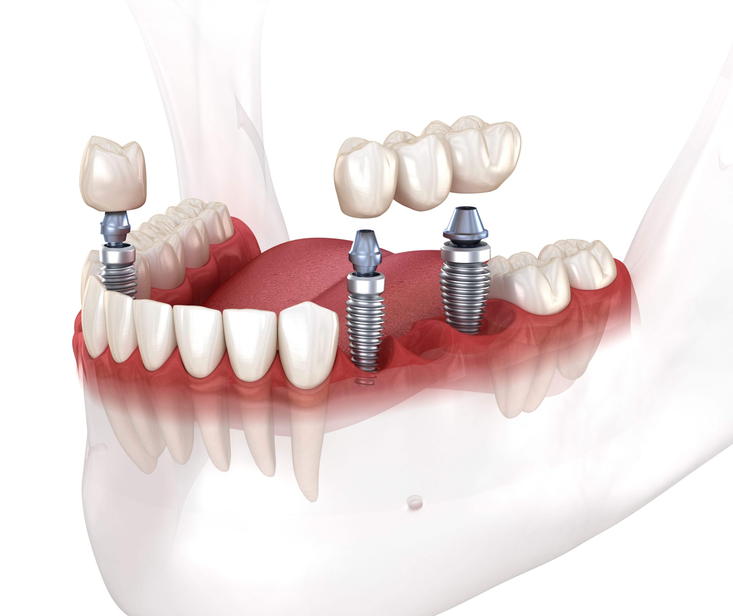 Multiple Tooth