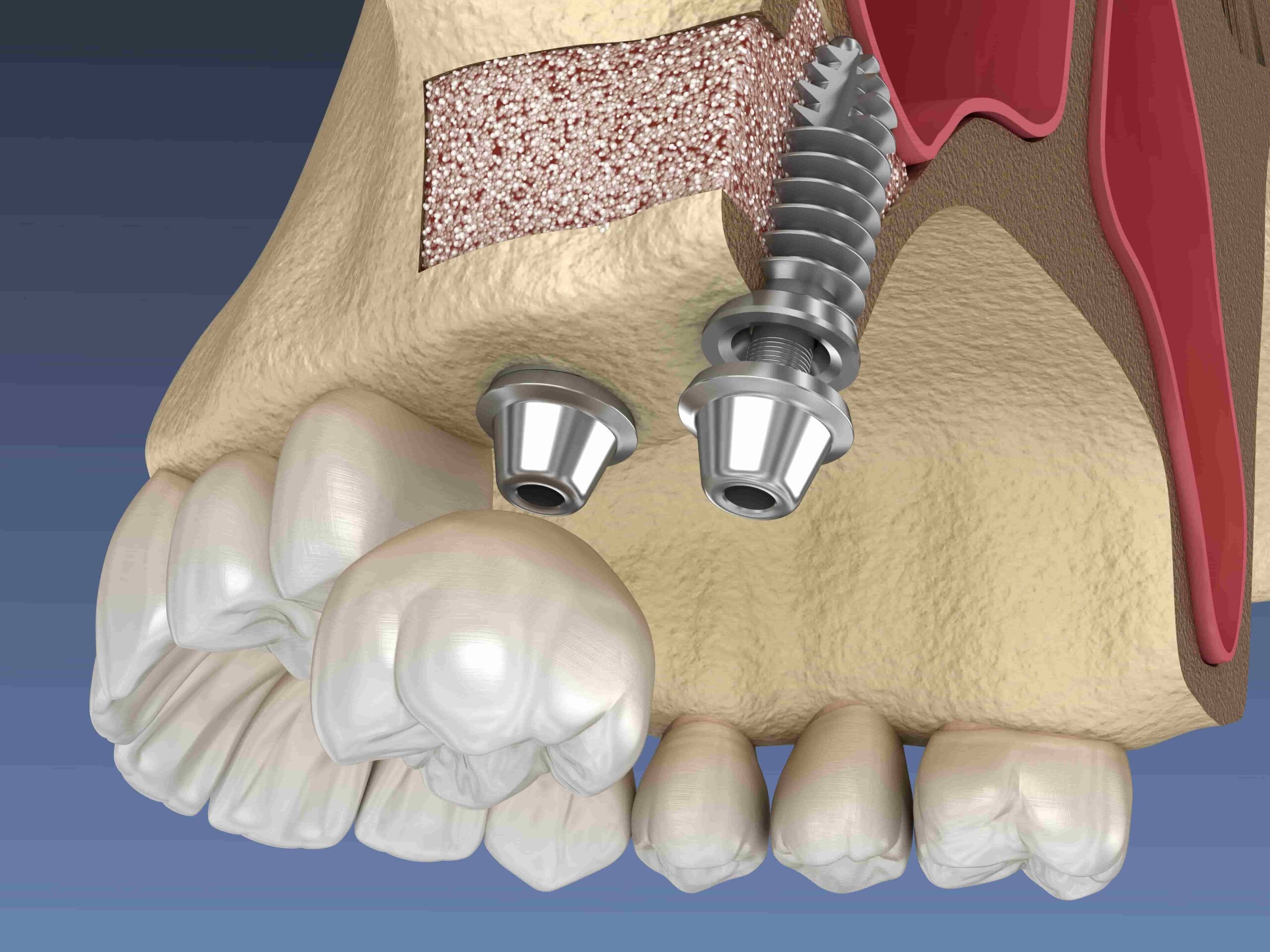 sinus lift Banner Image