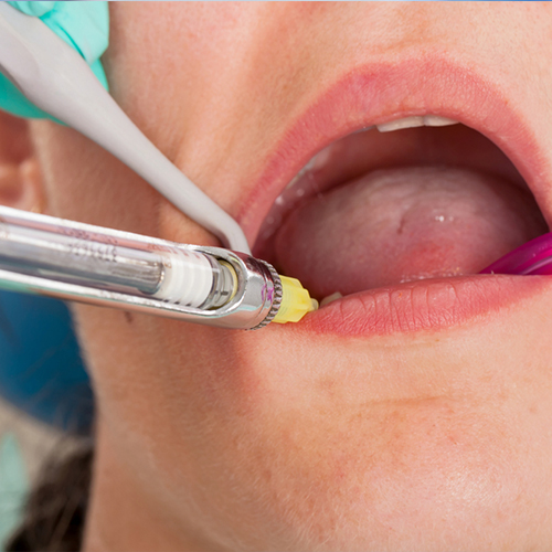 Local Anesthesia With Oral Pre-medication (Halcion)